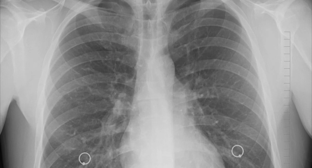 Zdrowe życie, Eksperci płuca wciąż późno wykrywany „Przebieg kliniczny bardzo podstępny” - zdjęcie, fotografia