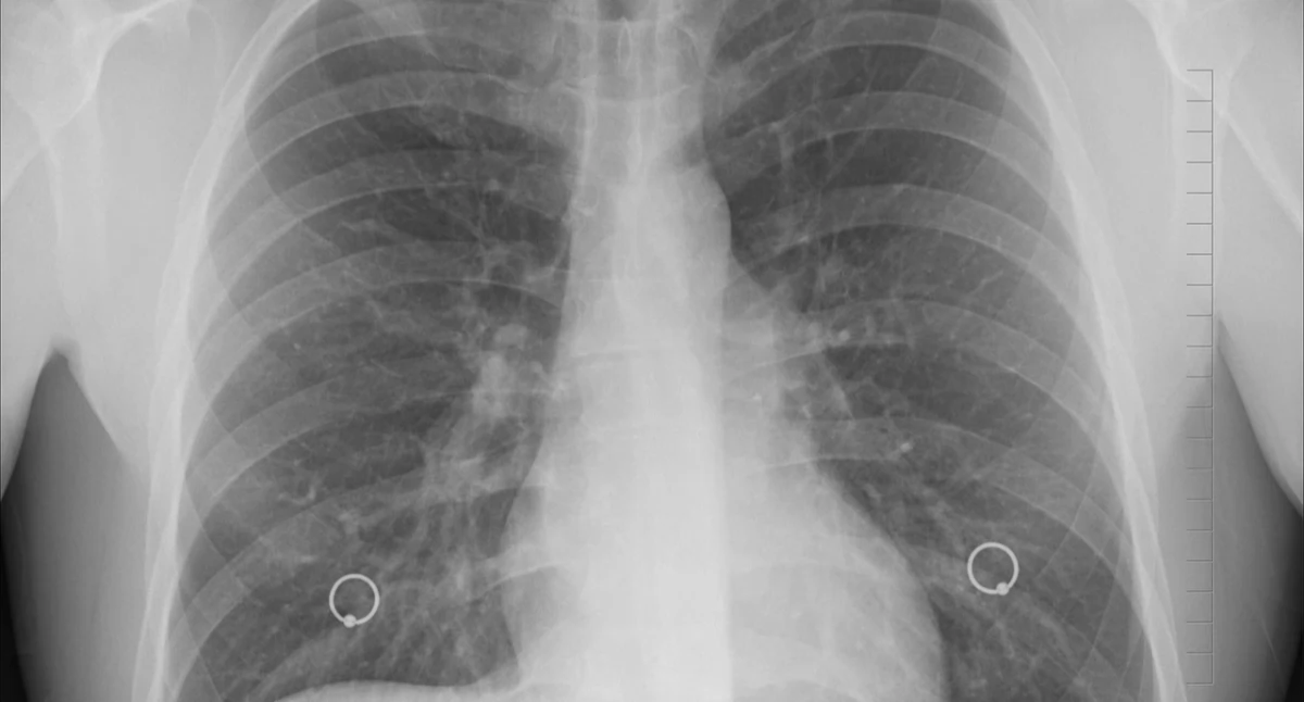 Badania kliniczne, moczu pomoże wczesnym wykrywaniu płuc - zdjęcie, fotografia