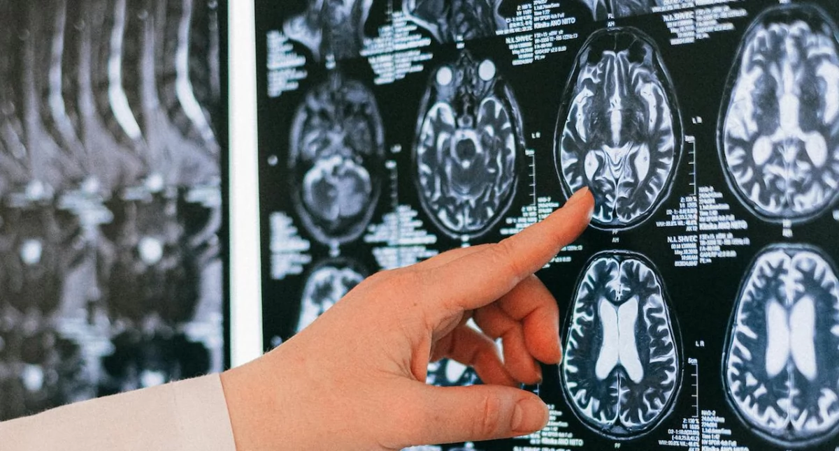 Zdrowe życie, Postępy leczeniu stwardnienia rozsianego jutro konferencja neurologiczna Łodzi - zdjęcie, fotografia