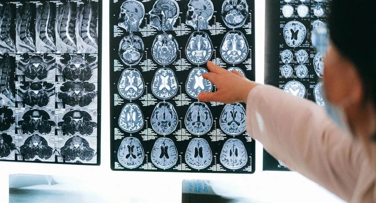 Zdrowe życie, Polsce osób cierpi epilepsję Choroba może wywoływać silny - zdjęcie, fotografia