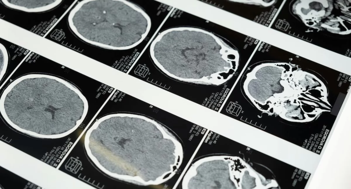 Badania kliniczne, metoda badania węchu wzroku nadzieję wcześniejszą diagnozę choroby Parkinsona - zdjęcie, fotografia