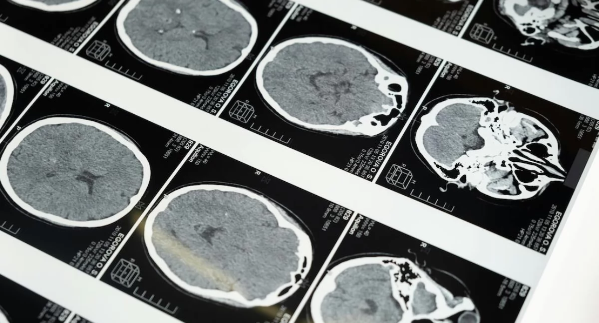 Badania kliniczne, model pozwala diagnozować nowotwory mózgu ryzykownych biopsji - zdjęcie, fotografia