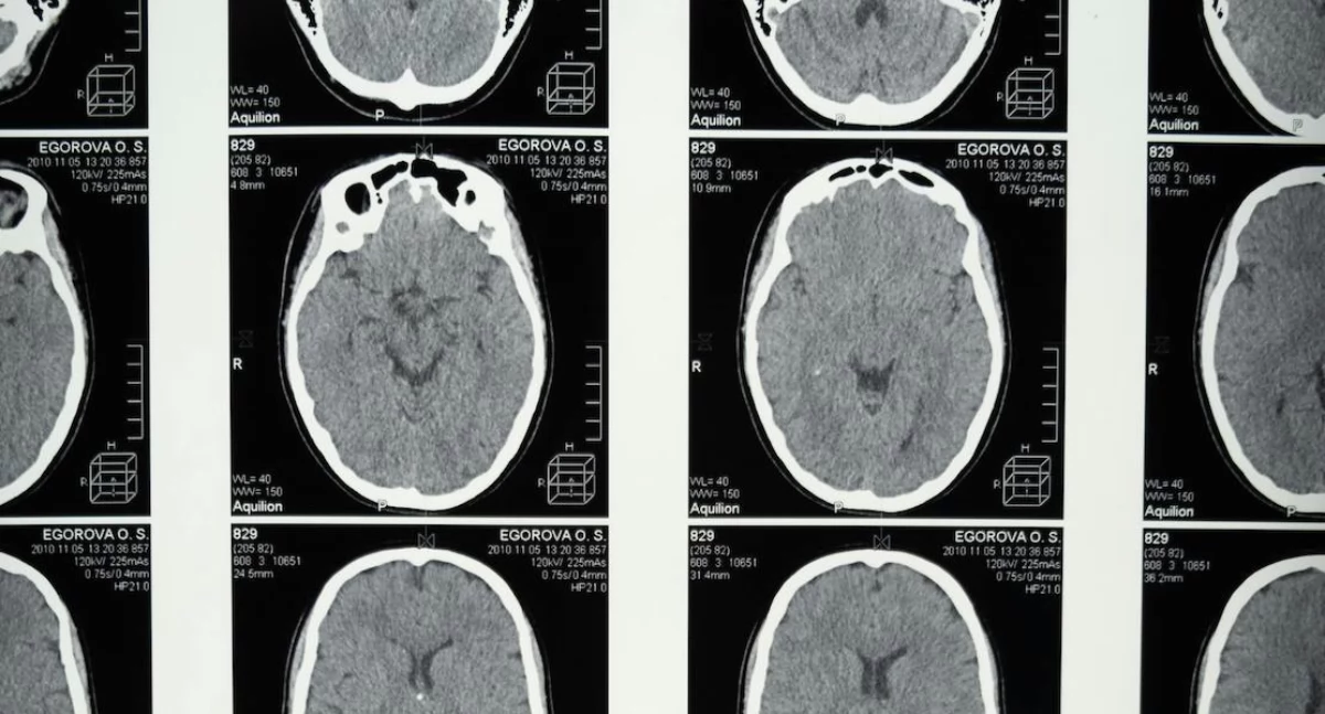 Badania kliniczne, Światło przechodzi przez ludzką głowę Naukowcy Glasgow łamią granice obrazowania mózgu - zdjęcie, fotografia