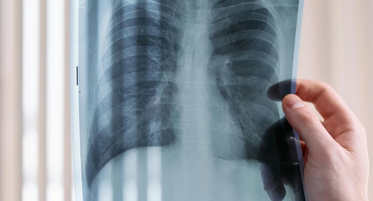 Leki, płuca staje Polsce niemal epidemią Eksperci Diagnostyka długo pacjent przestaje kandydatem leczenia - zdjęcie, fotografia