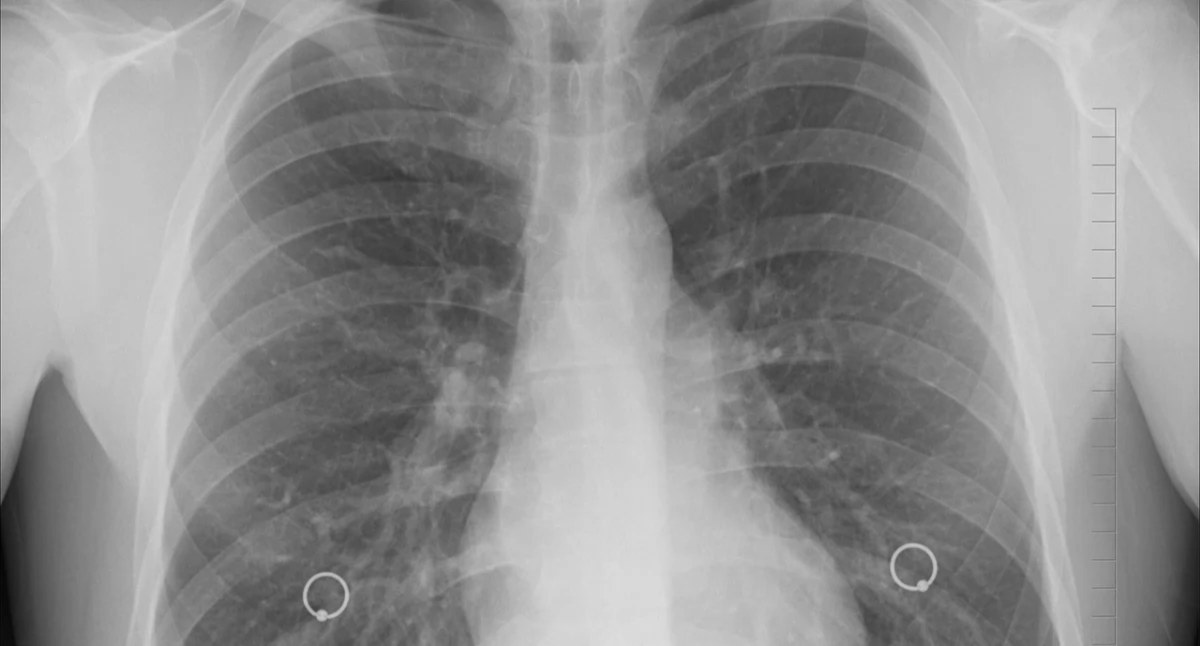 Badania kliniczne, Radioterapia pomocą algorytmu poprawia dokładność leczenia płuc - zdjęcie, fotografia