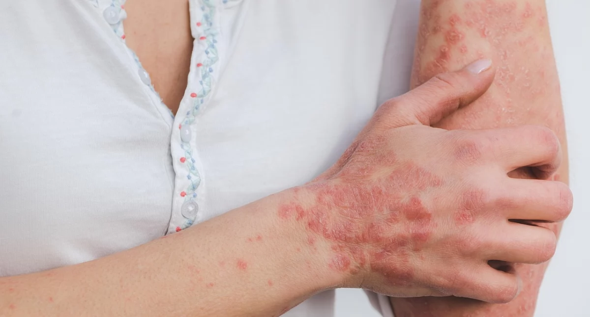 Leczenie, terapie, Wyniszczająca bolesna choroba skóry rzadka jednak coraz częstsza Diagnoza przychodzi latach cierpienia - zdjęcie, fotografia
