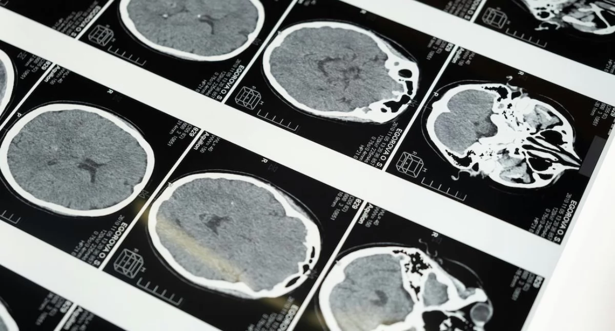 Zdrowe życie, Eksperci apelują Narodowy Diagnostyki Leczenia Chorób Mózgu - zdjęcie, fotografia