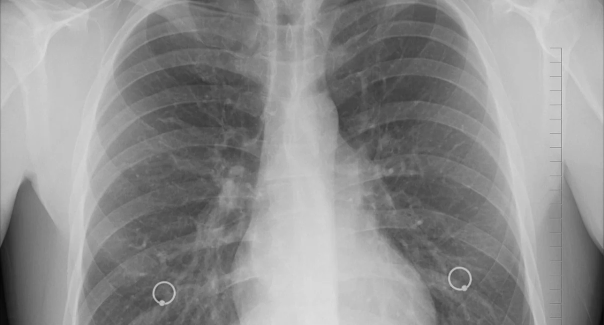 Badania kliniczne, CRISPR wykrywa gruźlicę plwocinie skutecznością - zdjęcie, fotografia