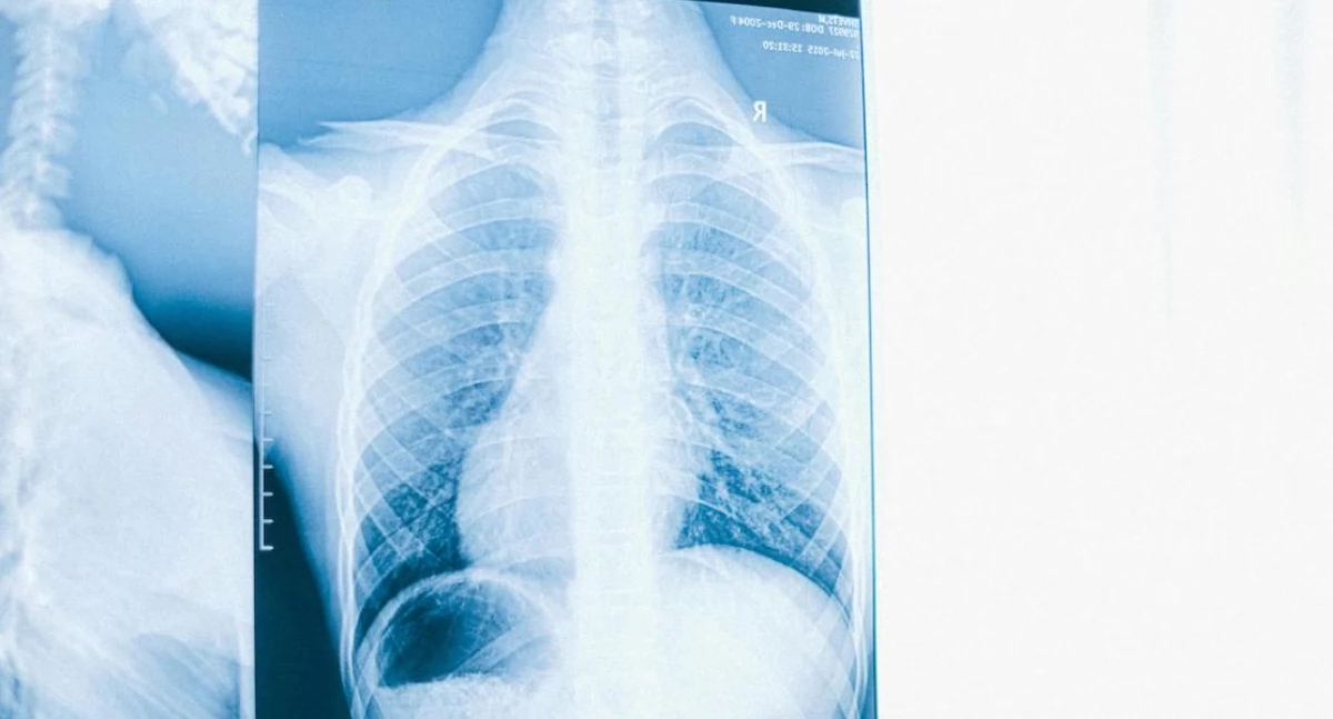 Badania kliniczne, Leczenie płuca intencją wyleczenia Polska czeka refundację innowacyjnych leków - zdjęcie, fotografia