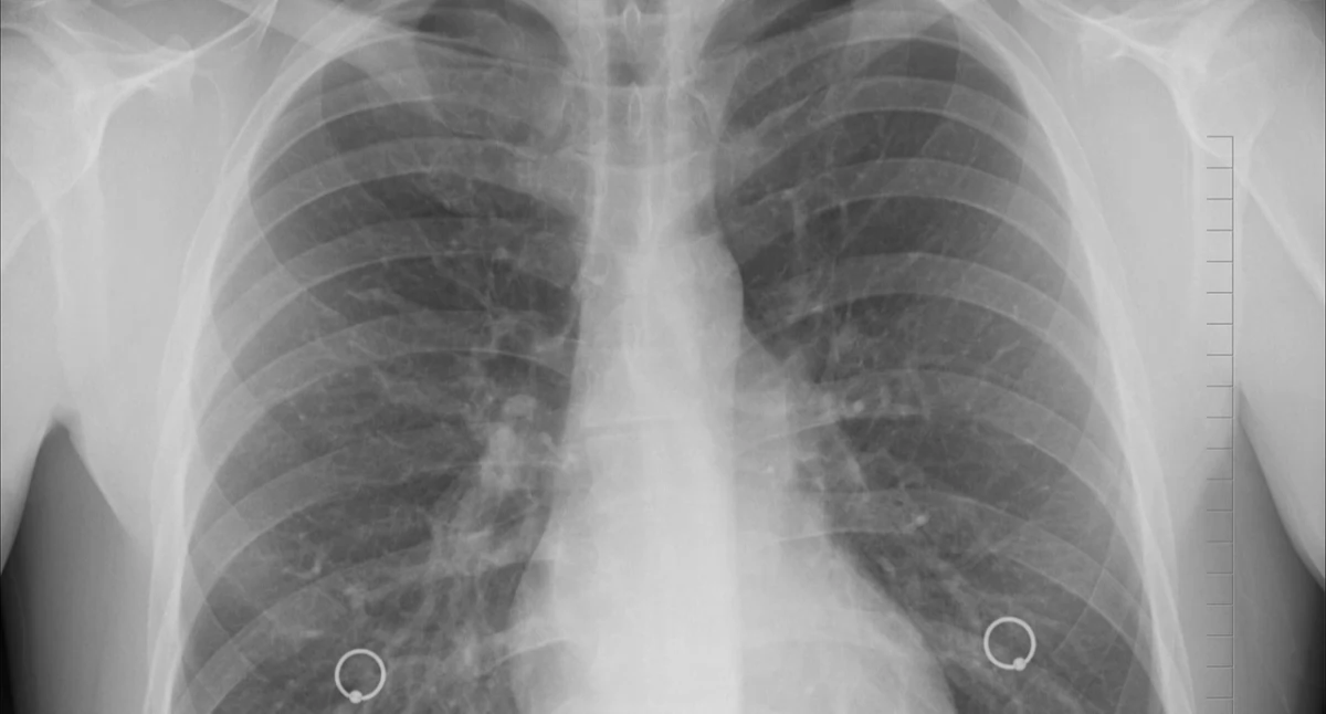 Raporty, analizy, rankingi, Eksperci diagnostyki molekularnej odbiera chorym szansę skuteczne leczenie płuca - zdjęcie, fotografia