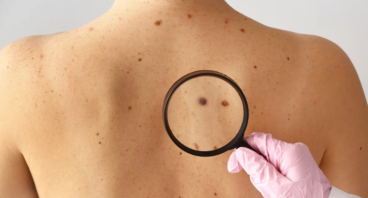 Badanie pieprzyka na plecach przy pomocy lupy, dermatoskopu.