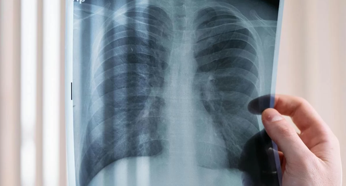 Badania kliniczne, Prawie życia zaawansowanym rakiem płuca przełomowe wyniki badania FLAURA - zdjęcie, fotografia