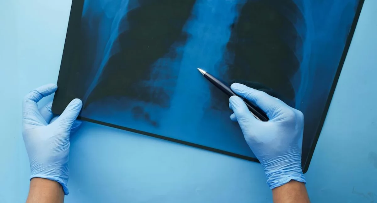 Badania kliniczne, Nerandomilast zmniejsza ryzyko zgonu pacjentów włóknieniem płuc obiecujące badań FIBRONEER - zdjęcie, fotografia