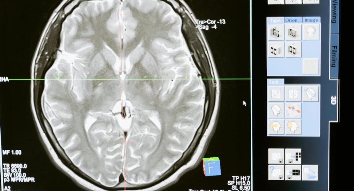 Zdrowie psychiczne, Schizofrenia może związana niedoborem żelaza mieliny mózgu dowody badań - zdjęcie, fotografia