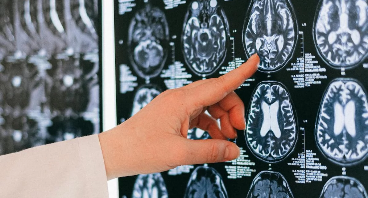 Badania kliniczne, Spersonalizowana stymulacja mózgu zmniejsza napady pacjentów lekooporną padaczką - zdjęcie, fotografia