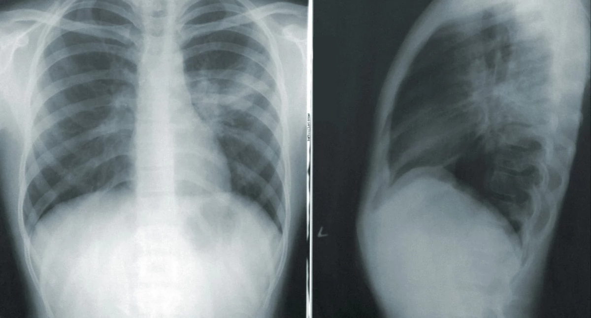 Badania kliniczne, przełom leczeniu płuca zmniejszył nawet - zdjęcie, fotografia