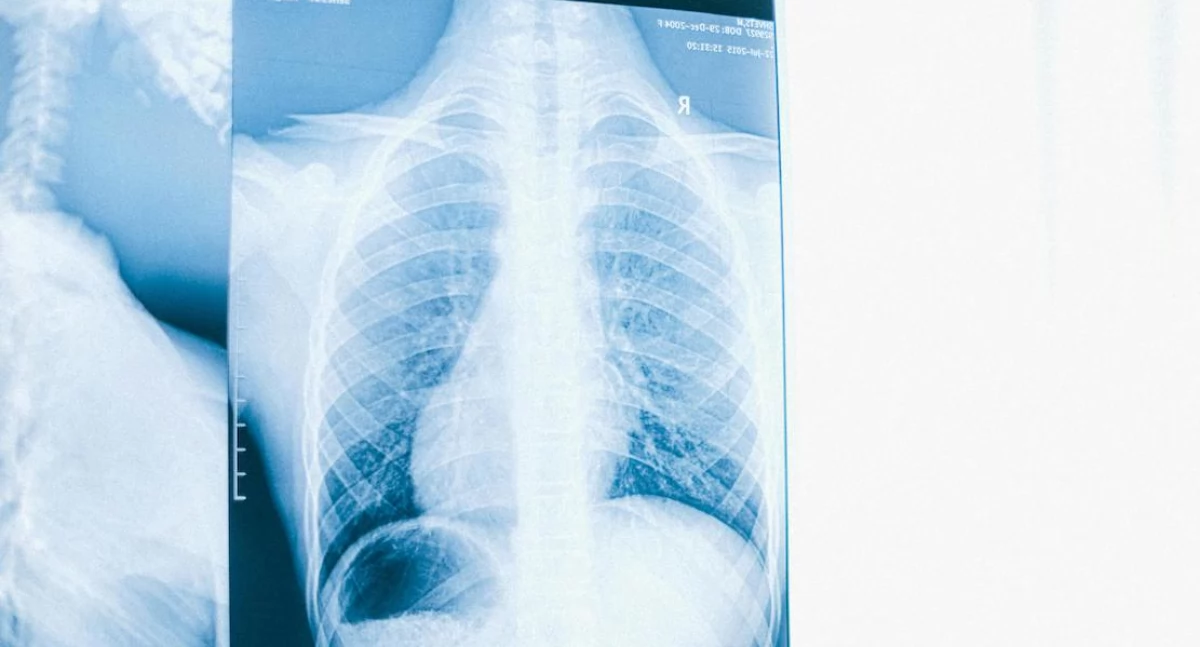 Badania kliniczne, płuc wciąż zabija najczęściej choć prosta tomografia mogłaby zapobiec - zdjęcie, fotografia