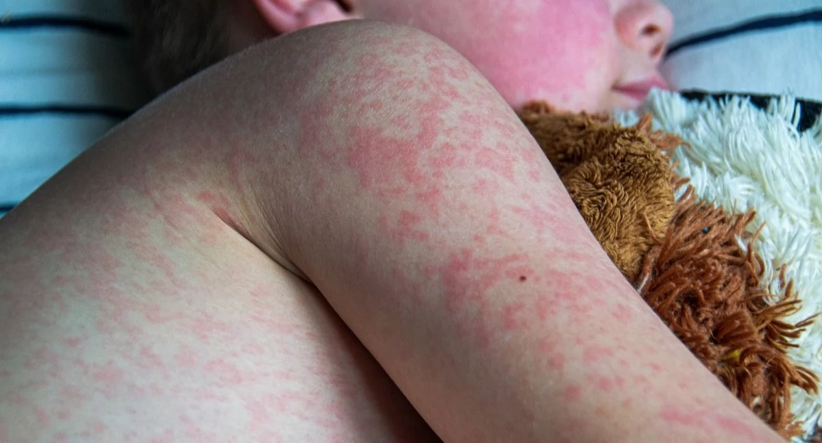 W Polsce, przypadki Polce Sanepid prowadzi dochodzenie epidemiologiczne - zdjęcie, fotografia