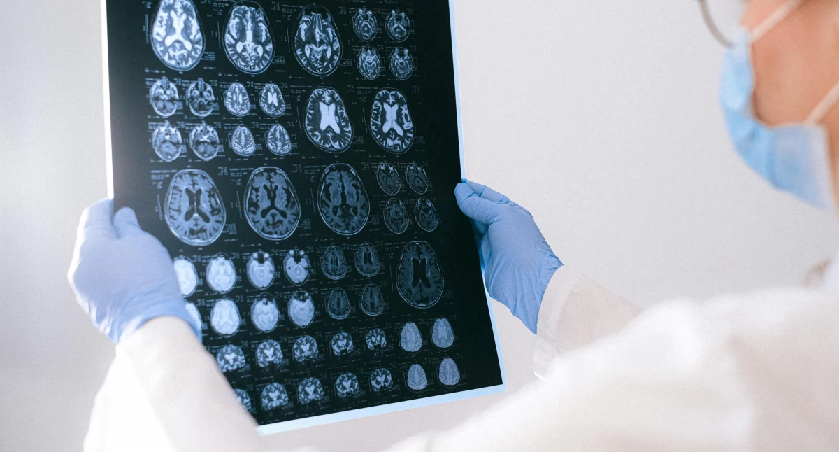 Leczenie, terapie, Regularne badanie tętna ryzyko udaru mózgu Dlaczego kontrola pulsu znaczenie kliniczne - zdjęcie, fotografia