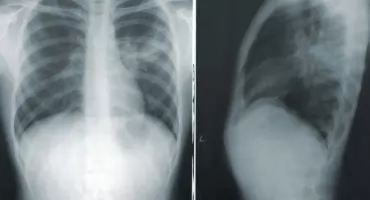 NFZ sfinansuje badania przesiewowe raka płuca. Niskodawkowa tomografia już nie tylko w pilotażu