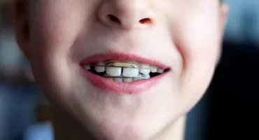 Co zrobić w wybitym zębem na wakacjach? Wsadź go do mleka